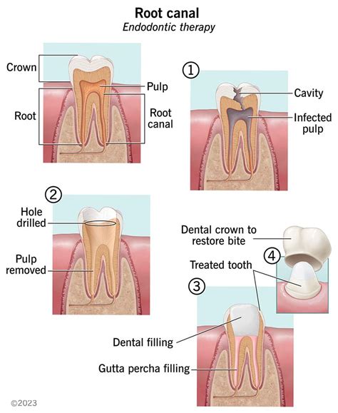 Root Canal: Procedure, What It Treats 